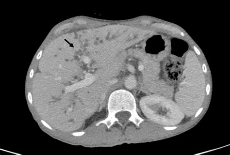 Cureus | Assessment of Three-Phasic CT Scan Findings of Cirrhosis Due to Primary Sclerosing ...