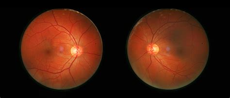 Retinal Diseases: Types, Symptoms, and Causes