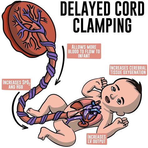 Delayed cord clamping in healthy term infants: More harm or good? - Seminars in Fetal and ...