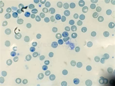 Reticulocyte Count from Blood Smear Hematology. Stock Photo - Image of immature, circle: 254433024