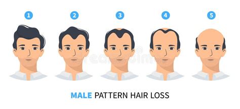 Hair Loss Stages, Androgenetic Alopecia Male Pattern Stock Vector ...