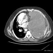 Hemangiopericytoma | Radiology Reference Article | Radiopaedia.org