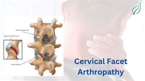 Cervical Facet Arthropathy Non-Surgical Treatment | Top Pune Clinic | Best Back Pain, Slip Disc ...