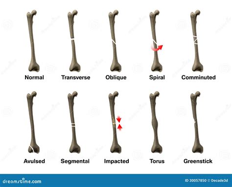 Todos Los Tipos De Fracturas De Hueso Foto de archivo - Imagen de cuidado, imagen: 30057850