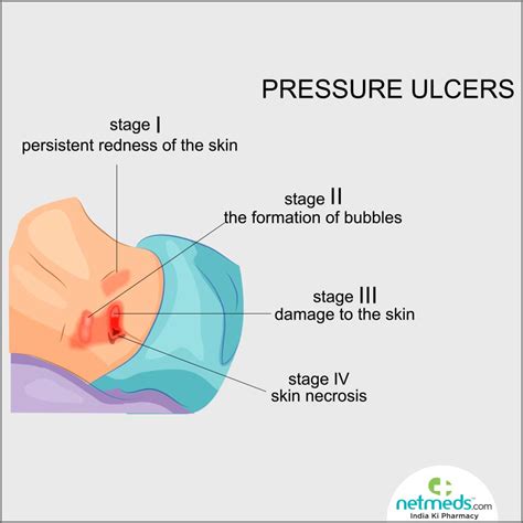 Pressure Ulcers/Decubitus: Causes, Symptoms And Treatment