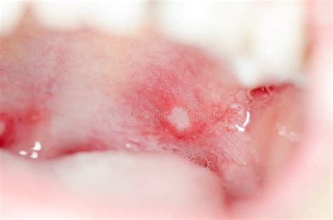 Infection Of Ulcer Inside Mouth Stock Image - Image of infection, girl: 80069375