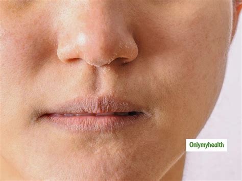 Causes Of Dry Skin Around The Mouth | OnlyMyHealth