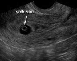 Abdominal or vaginal ultrasound - Somerset Early Scans