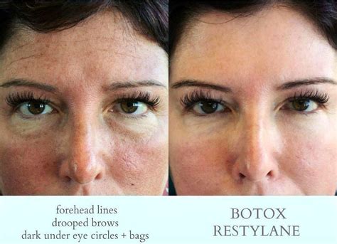 Eyebrow Lift Using Botox » Eyelid Surgery: Cost, Photos, Rewiews, Q&A