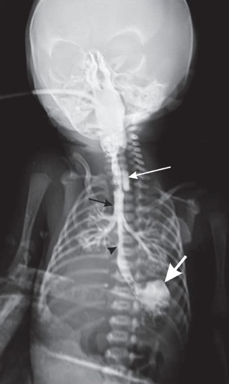 Esophageal Atresia and Tracheoesophageal Fistula | Concise Medical Knowledge