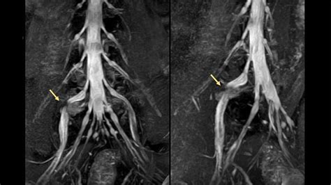 MRI nerve visualization informs surgery | FieldStrength | Philips