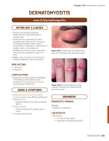 Juvenile Dermatomyositis Jdm Symptoms Causes Diagnosis