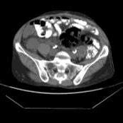 A non-enhanced serial CT scan of the patient's abdomen after 4 cycles... | Download Scientific ...