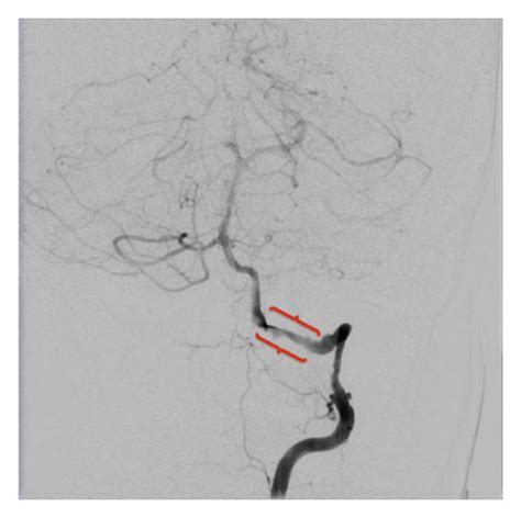 Cerebral angiography shows right vertebral artery dissection right past ...