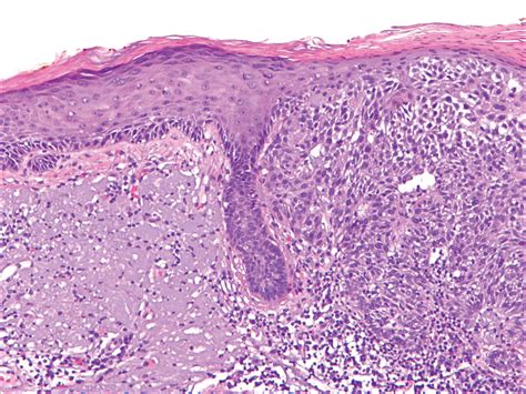 Actinic Keratosis as a Marker of Field Cancerization in Excision Specimens of Cutaneous ...