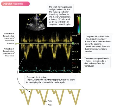 Doppler effect and Doppler echocardiography – Cardiovascular Education