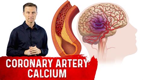 How to Read a Coronary Artery Calcium (CAC) Score - YouTube