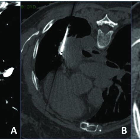 Cryoablation procedure: (A) contrast-enhanced axial CT scan showing a ...