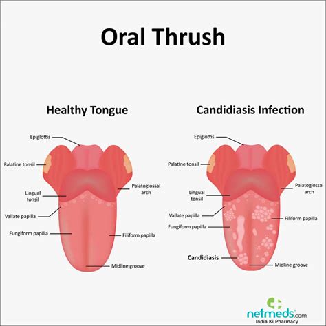 Oral Thrush - Causes, Symptoms And Treatment