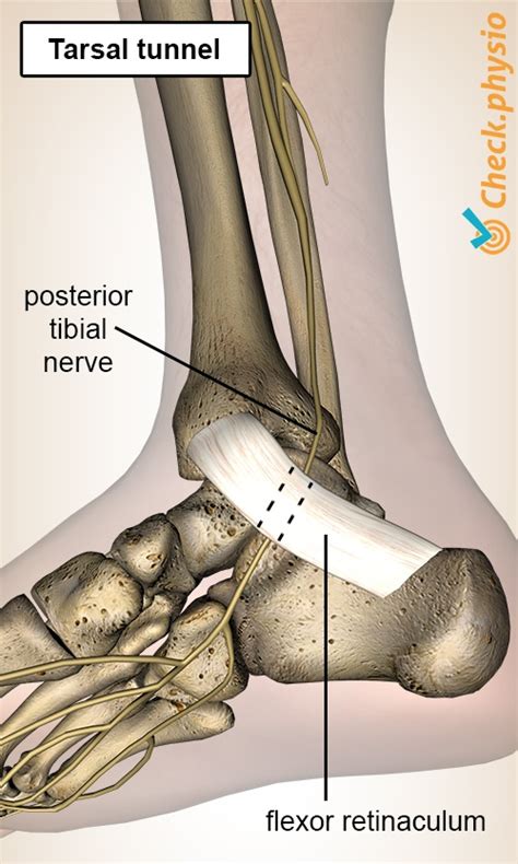 Tarsal tunnel syndrome | Physio Check