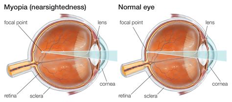 Myopia