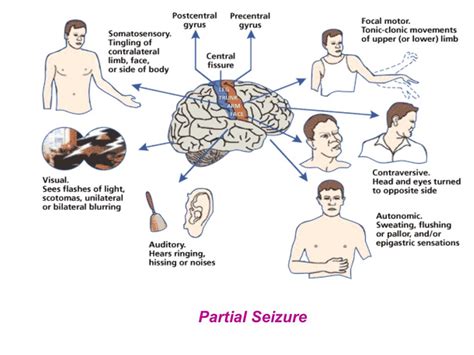 Seizures disorder