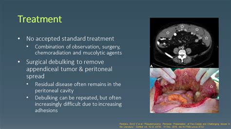 Pseudomyxoma Peritonei (AKA Jelly Belly) | SCVMC IM Chief Resident Blog