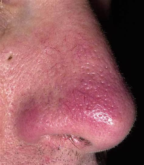 List 91+ Pictures What Is A Purple Nose A Symptom Of Latest