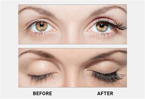 Latisse - Eyelash Growth Treatment in Fresno & Madera, CA