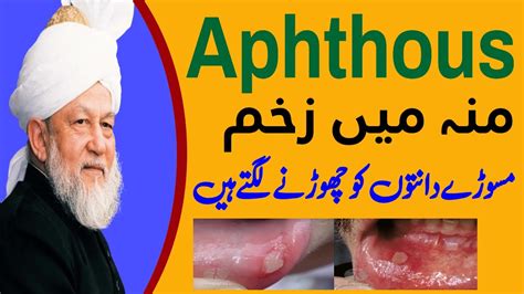 Aphthous treatment. منہ میں زخم اورمسوڑوں کے مسائل - YouTube