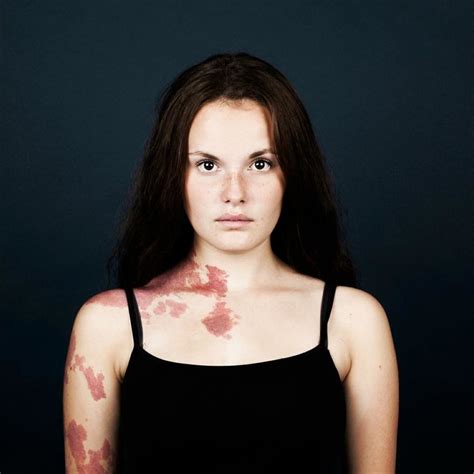 10+ Portraits Of People With Birthmarks That Might Change The Way You ...