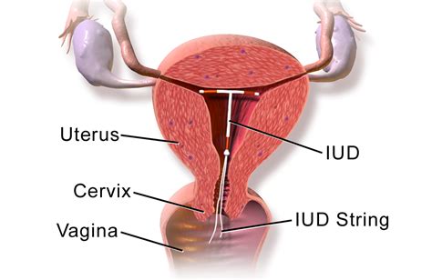 About The IUD