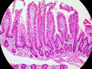 GI – Duodenum and Small Bowel – Pathologia