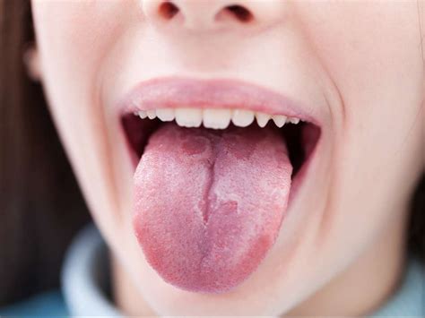 Psoriasis on the tongue: Symptoms, treatment, and prevention