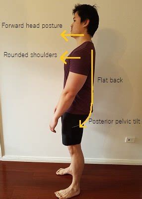 How to fix Flat back posture - Posture Direct