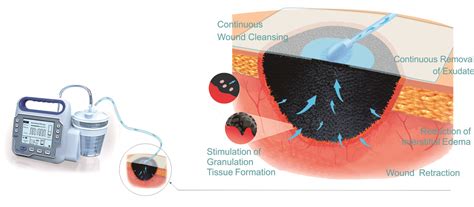 Foryou NPWT: Negative Pressure Wound Therapy by 4L Health