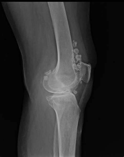 Synovial chondromatosis | Radiology Reference Article | Radiopaedia.org | Radiology, Knee, Reference