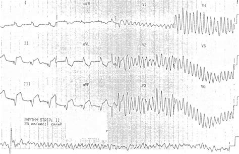 ECG Case 057 • LITFL • ECG Top 100 Self-Assessment Quiz