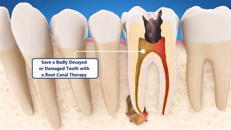 Save a Badly Decayed or Damaged Tooth with a Root Canal Therapy Root ...