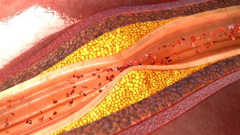 Keto and ME/CFS (Part III): lipid models and the lean mass hyper-responders (LMHR) – Frozen in Amber