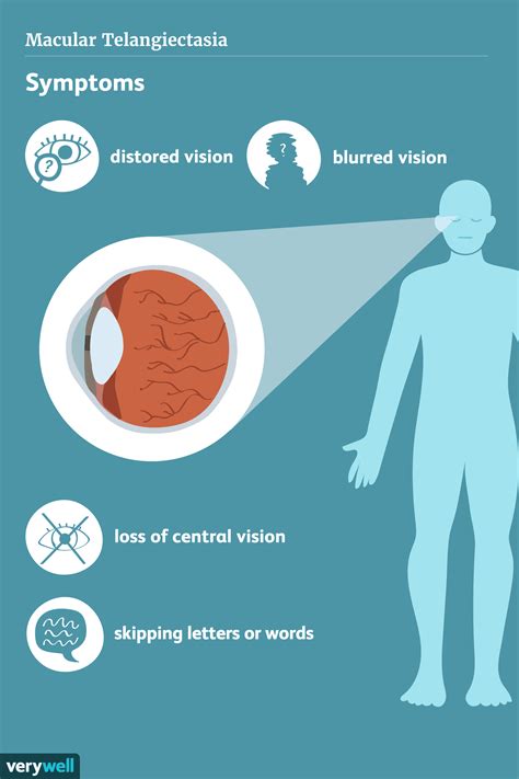 Macular Telangiectasia: Types, Symptoms, Diagnosis, Treatment