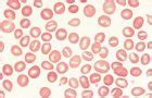 Stomatocytosis | Ask Hematologist | Understand Hematology