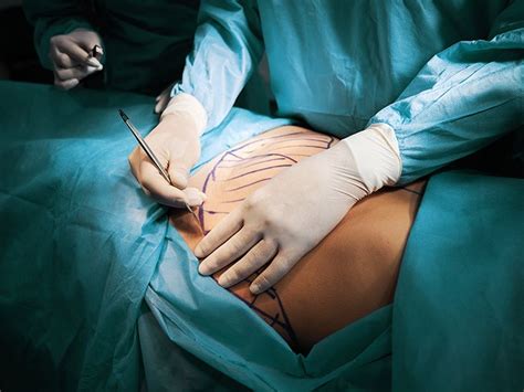 Tummy Tuck: Purpose, Procedure, Before and After Photos, and More