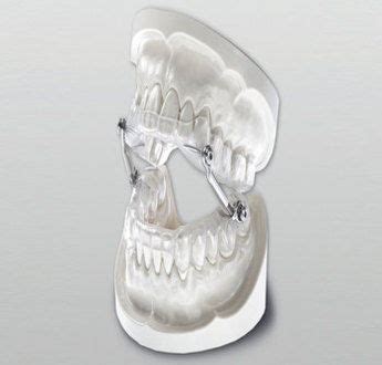 Understanding Sleep Apnea Mouthpieces | The Snoring Mouthpiece Review