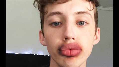 Kylie Jenner Lip Challenge Gone Wrong - Famous Person