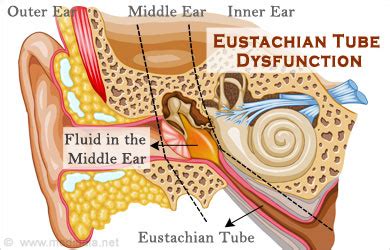 Eustachian Tube Dysfunction - Causes, Symptoms, Diagnosis, Treatment