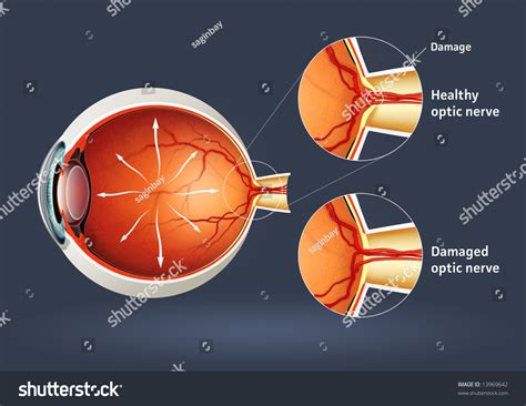 Human Eye - Glaucoma (Eye Disease) Stock Photo 13969642 : Shutterstock