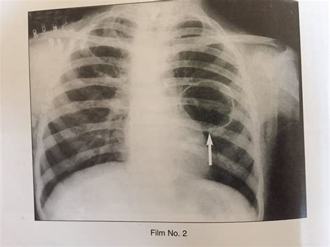 Pneumatocele O Que é - RETOEDU