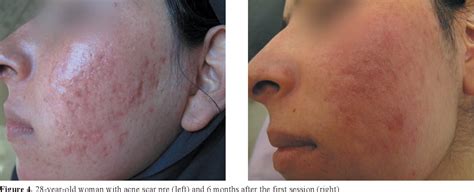 Figure 3 from Evaluation of Fractional CO2 Laser Efficacy in Acne Scar | Semantic Scholar