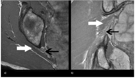 Sciatic Foramen Mri